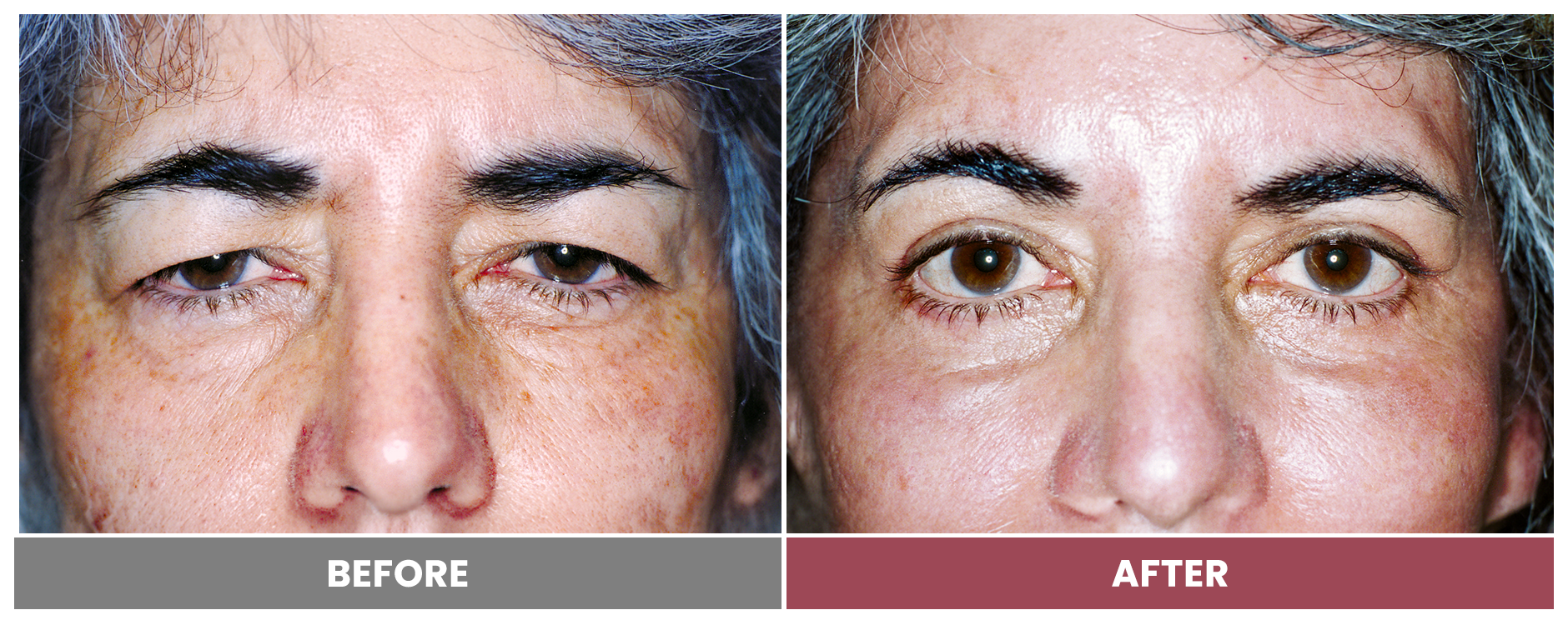 Upper Blepharoplasty - Case 96
